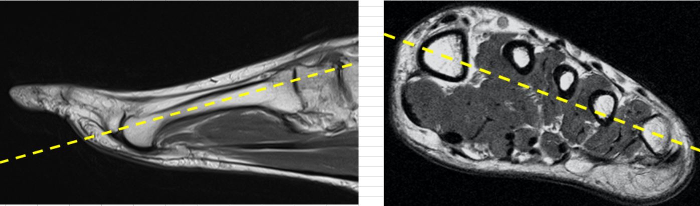 MR Foot (Midfoot / Forefoot) – RIA Protocols